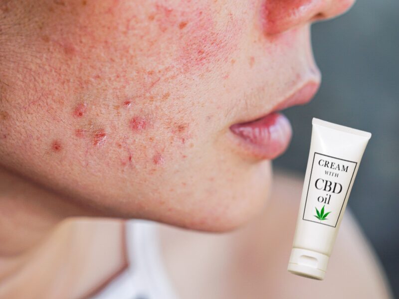 Portada ¿Puede el CBD ayudar con las manchas en la piel?